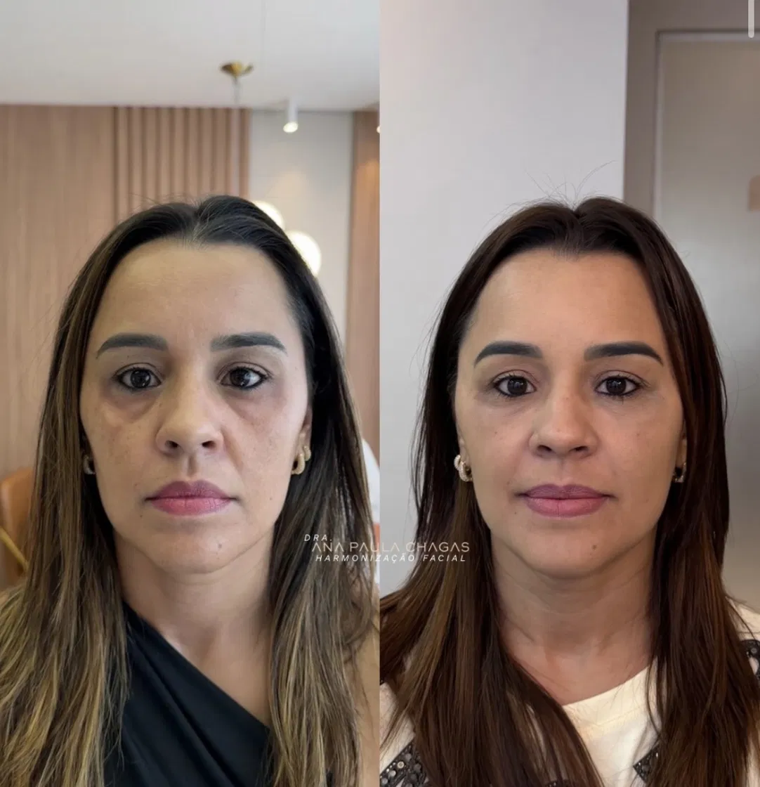 Resultado de harmonização facial, antes e depois