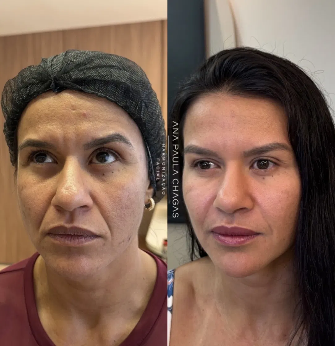 Resultado de harmonização facial, antes e depois