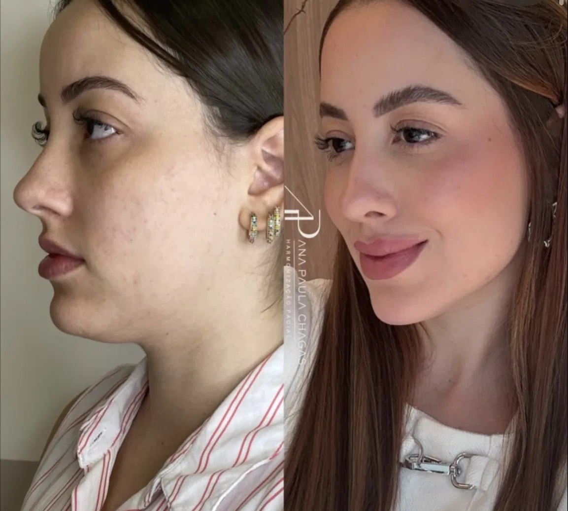 Resultado de harmonização facial, antes e depois